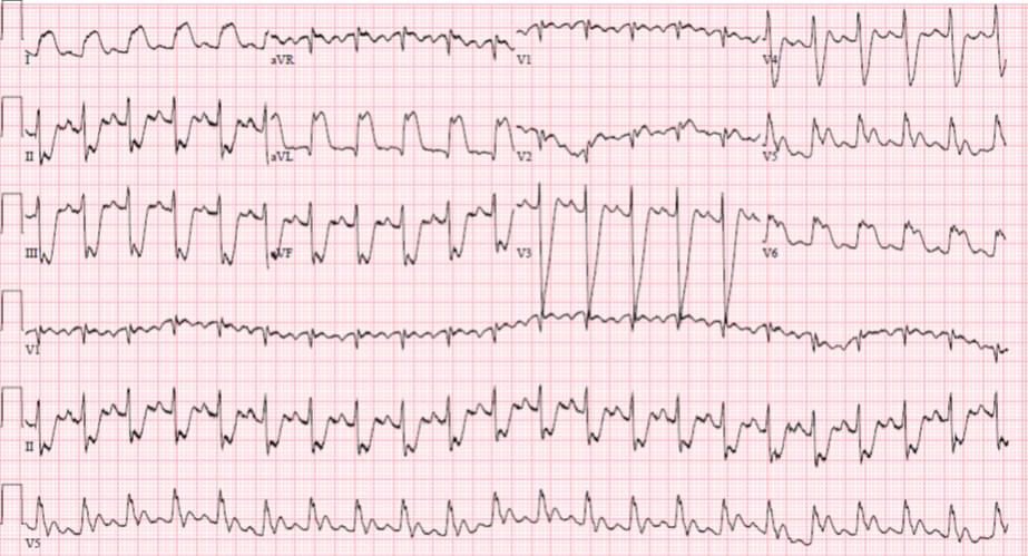 jzalkin's tweet image. For @RachelAlter007 and her ❤️💔❤️ of cardiology: #FOAMed #ECG #codeSTEMI A 16 yo girl has syncope:  hqmeded-ecg.blogspot.com/2014/05/a-16-y…