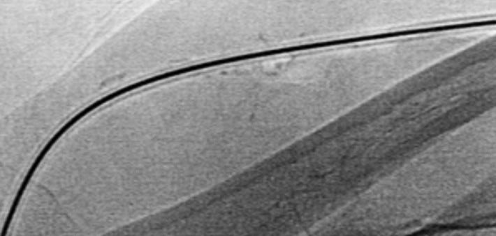 Reservorio subcutáneo yugular izquierdo con 10 años de antigüedad, ¿retirarlo es sencillo?  #irad #IRrookie <a href="/SIDISoc/">SIDI</a> <a href="/RevIntervenc/">Intervencionismo. Interventional science journal.</a>