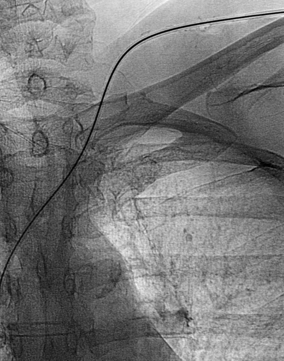 IradPTY's tweet photo. Reservorio subcutáneo yugular izquierdo con 10 años de antigüedad, ¿retirarlo es sencillo?  #irad #IRrookie @SIDISoc @RevIntervenc https://t.co/fXTlBA9rkD