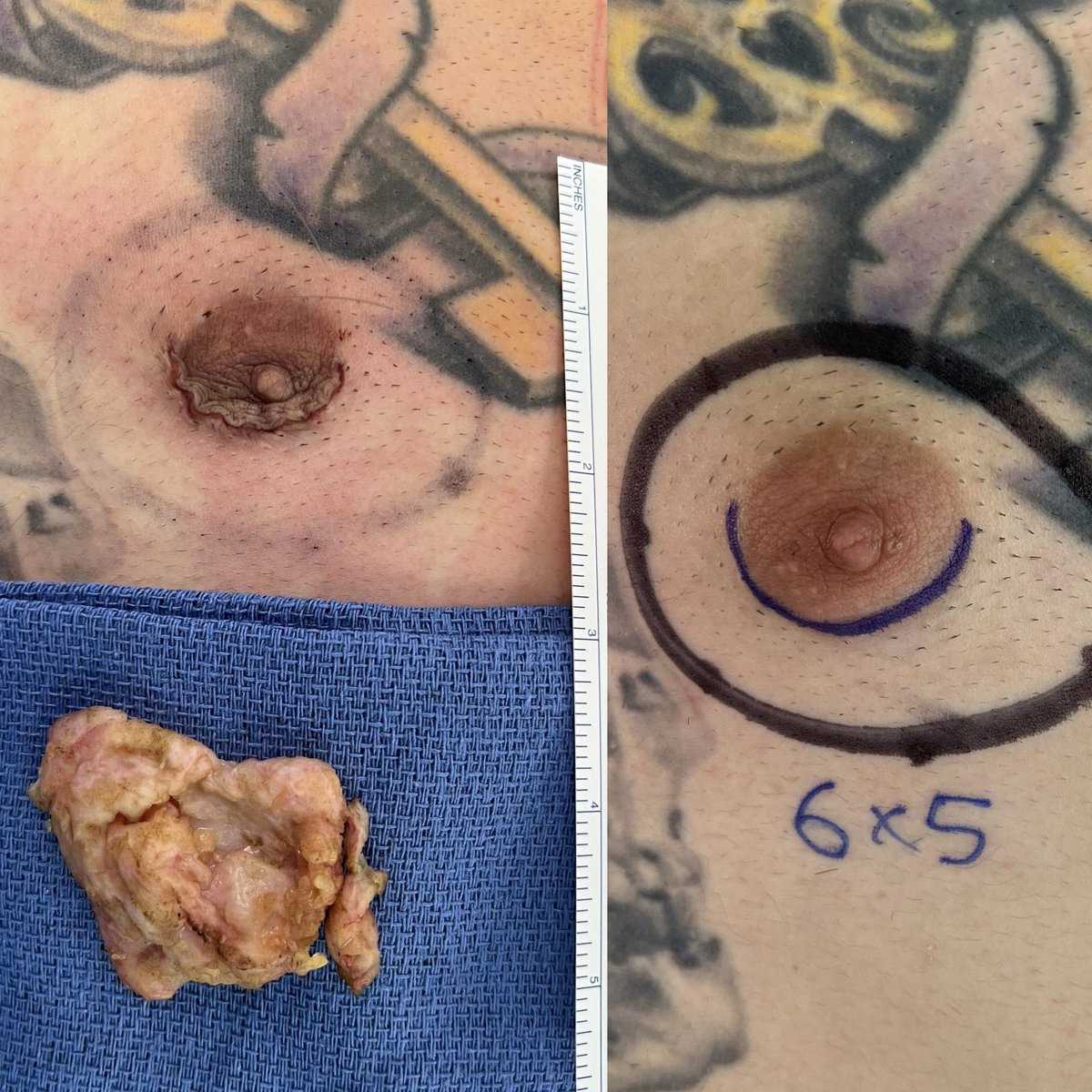 LivingstonMD's tweet photo. Gynecomastia requires surgical removal of the male breast gland @ASPSMembers #gynecomastia #malebreasts #mastectomy https://t.co/YIk6TBnlLb https://t.co/8BKcxT47hF