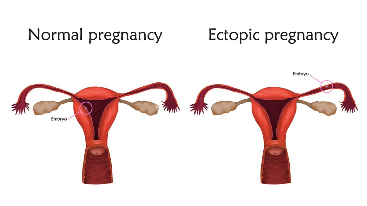 USCFertility's tweet photo. What is an #ectopicpregnancy? Find out here: https://t.co/KMpiXfkq9t

Contact @USCFertility for expert advice: (213) 975-9990

#fertility #fertilityspecialists #fertilityclinic #infertility #infertilityawareness #losangles #usc #uscfertility #reproductivemedicine #ttc #pregnancy https://t.co/7iGgw9CirQ