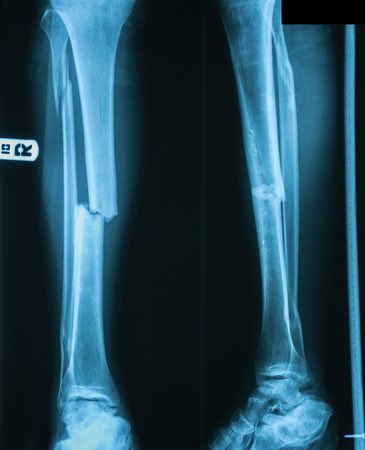 PedroBotelloRD's tweet photo. Sálvese quien pueda mi primo acaba de fracturarse las dos piernas, pero ARS FUTURO dice que la fractura que él eligió no está en el catálogo y le niegan cobertura. Qué hago ? Esperar terminar la reforma a la ley 87-01 @DIDA_RDo  @luisabinader @raquelarbaje @DiputadosRD AUXILIÓ https://t.co/xccJyx9k3H