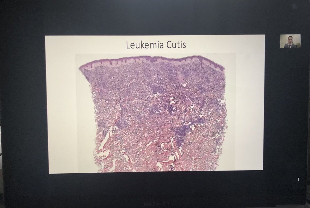 Dermpathl's tweet photo. ERG gets mentioned again today at #ASDP21 in the Special Topics Course: Essentials of Oncodermatopathology. “ERG may be a useful stain for evaluating leukemia cutis” - Dr Cuong Nguyen #dermpath #hemepath https://t.co/1x6UpNYX54