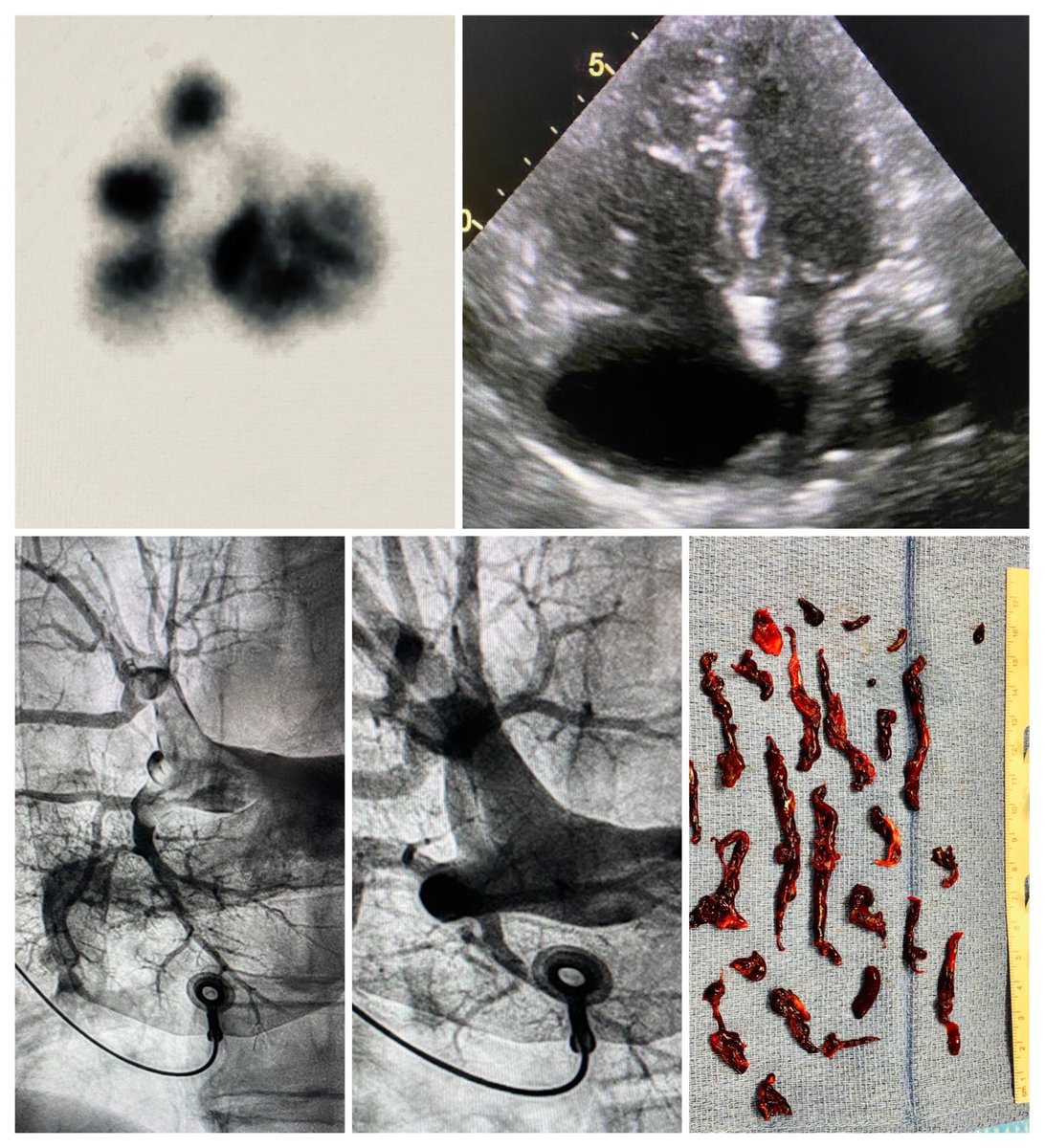 Malcolm T. Foster III, MD (@malcolmfoster3) on Twitter photo When it quacks like a duck: (no CTA due to CKD/ARF): hypoxemia, d-dimer, V/Q, RVD on echo. 12F computer assisted thrombectomy. 20 cc contrast. When it quacks like a duck: (no CTA due to CKD/ARF): hypoxemia, d-dimer, V/Q, RVD on echo. 12F computer assisted thrombectomy. 20 cc contrast.