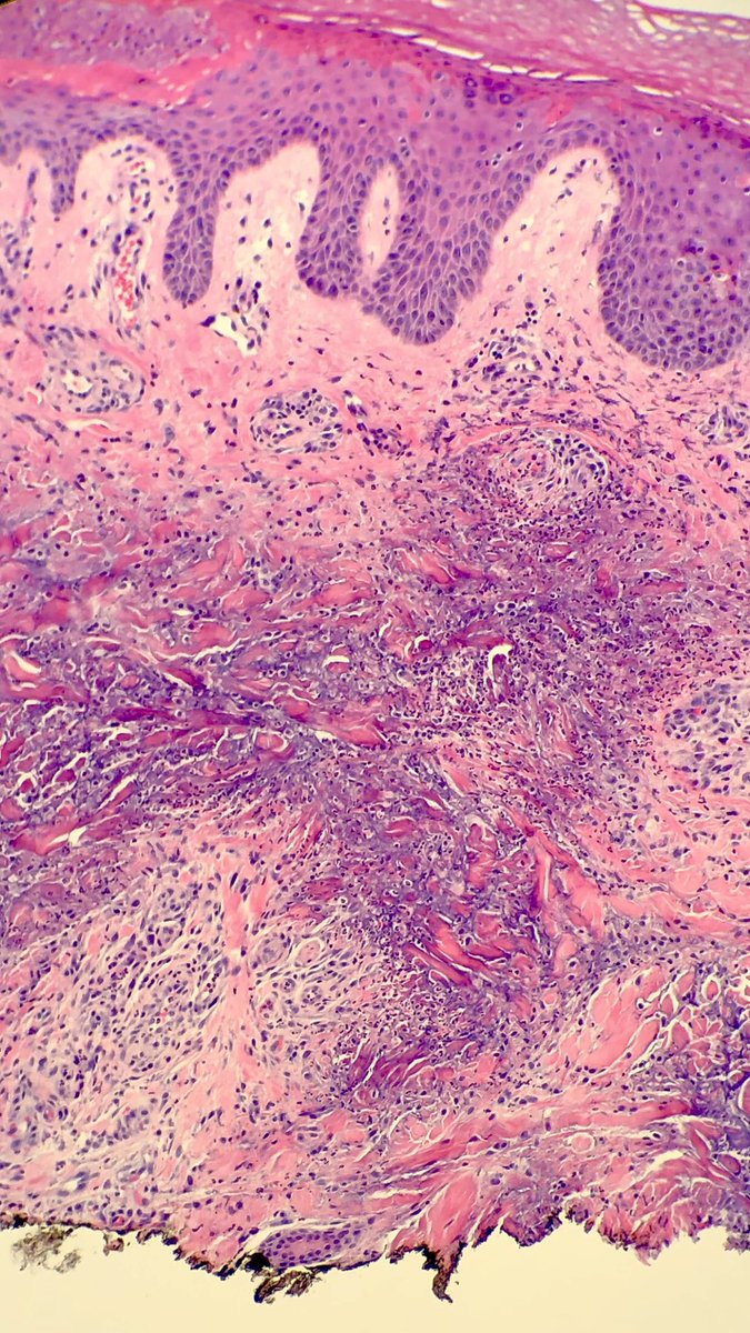 DCSkipperDO's tweet photo. 59-year-old woman from the abdomen. It’s been a while since I’ve seen one of these! #pathology #dermpath https://t.co/0JgDU7E4bv