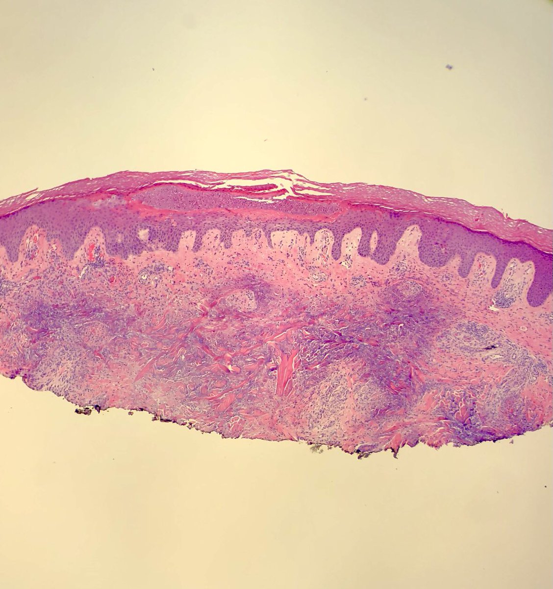 DCSkipperDO's tweet photo. 59-year-old woman from the abdomen. It’s been a while since I’ve seen one of these! #pathology #dermpath https://t.co/0JgDU7E4bv