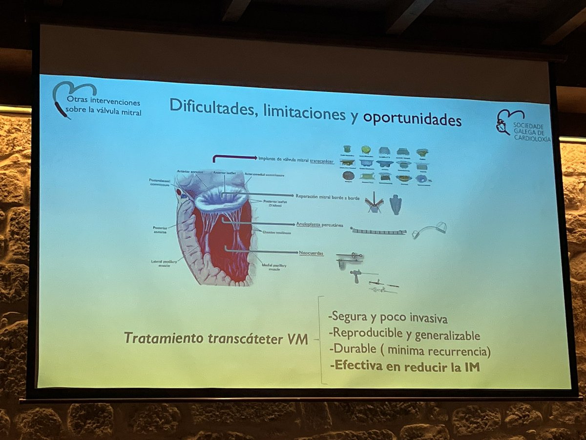 ramirotrillo's tweet photo. Obradoiro @SOGACAR sobre Intervencionismo Estructural. @belcid7 nos ilustra sobre otras intervenciones sobre la válvula mitral. Hoy ya son una realidad pero el futuro de estas técnicas es prometedor para nuestros pacientes. @HCASantiago @cardiologiaCHUS https://t.co/6g80eRg593