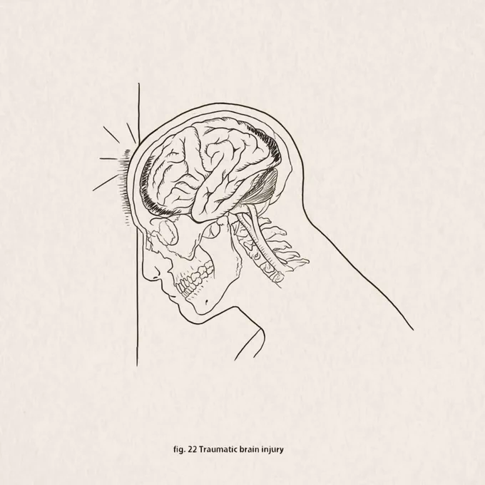 Fig. 22 Traumatic brain injury#sciartink #sciart #31figuresofsciart #medicalillustration #penandink #sciartober #sketch #medart 