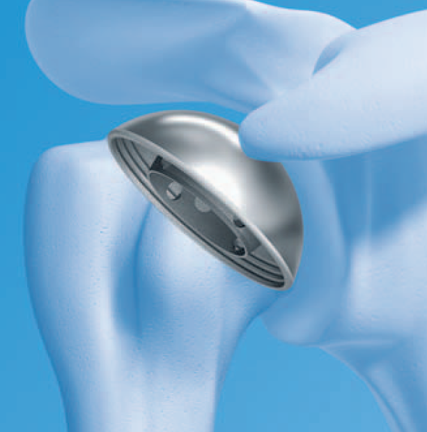 Congratulations <a href="/TJKarssiens/">Timothy Karssiens</a> on another paper reporting the good clinical outcomes of total shoulder arthroplasty, this time from <a href="/ESNEFT/">East Suffolk and North Essex NHS Foundation Trust</a> journals.sagepub.com/eprint/MKMV3E2… <a href="/kangsta77/">Niel Kang</a> <a href="/bowditch/">John Bowditch</a> <a href="/servant/">Servant</a> <a href="/lora_r_young/">Lora Young</a>  <a href="/eoeortho/">EoE Ortho</a> <a href="/orcapaedics/">Orthopaedic Research Collaborative east Anglia</a> #orthotwitter