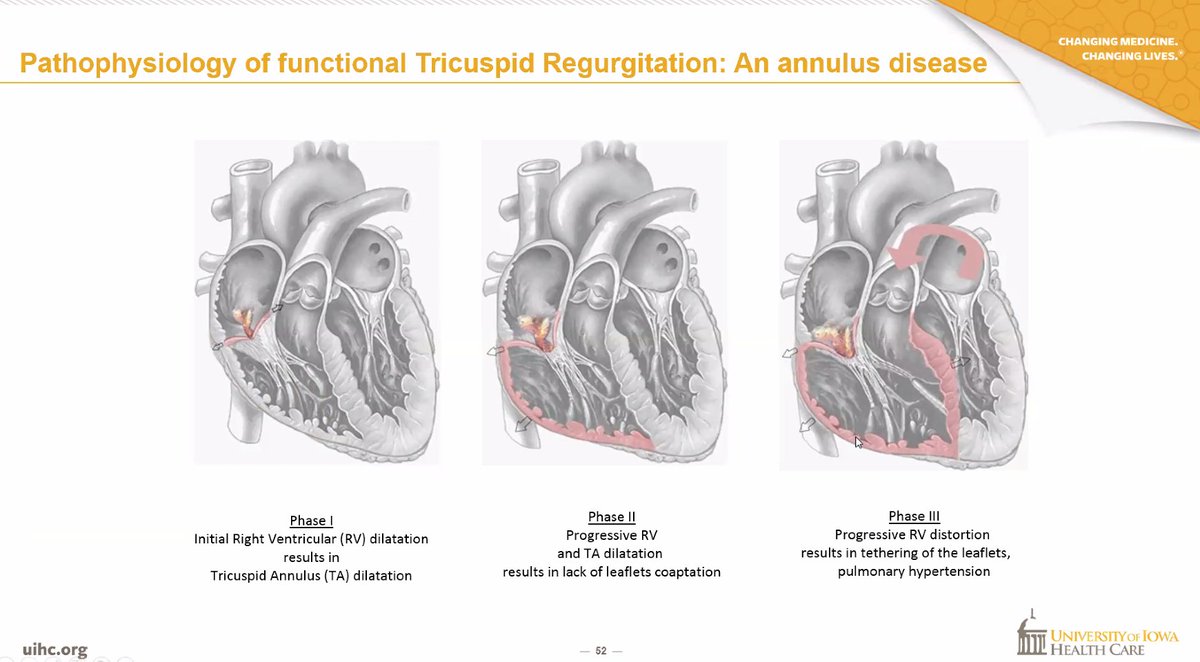 Michael Arustamyan (@mike_arustamyan) on Twitter photo Our very own Interventional/Structural Cardiologist, Dr. Panaich <a href="/SidakpalP/">Sidakpal Panaich</a> reviewing valvular heart disease and PCI for our <a href="/IowaACC/">Iowa Chapter of the American College of Cardiology</a> virtual chapter meeting. Our very own Interventional/Structural Cardiologist, Dr. Panaich <a href="/SidakpalP/">Sidakpal Panaich</a> reviewing valvular heart disease and PCI for our <a href="/IowaACC/">Iowa Chapter of the American College of Cardiology</a> virtual chapter meeting.