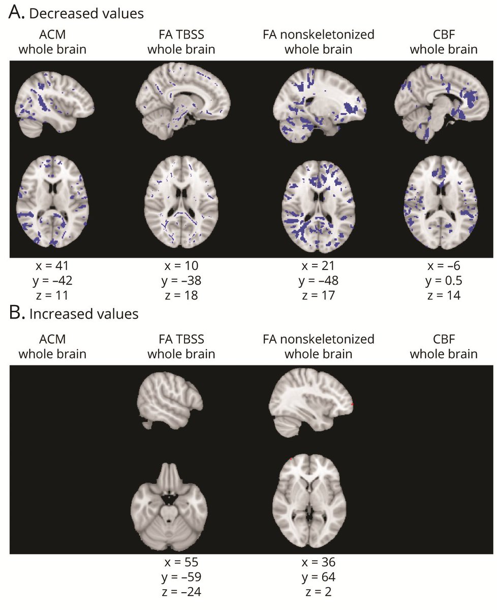 Mechanisms of Network Changes in Cognitive Impairment in Multiple Sclerosis: bit.ly/3B0XgrN #NeuroTwitter #MS
