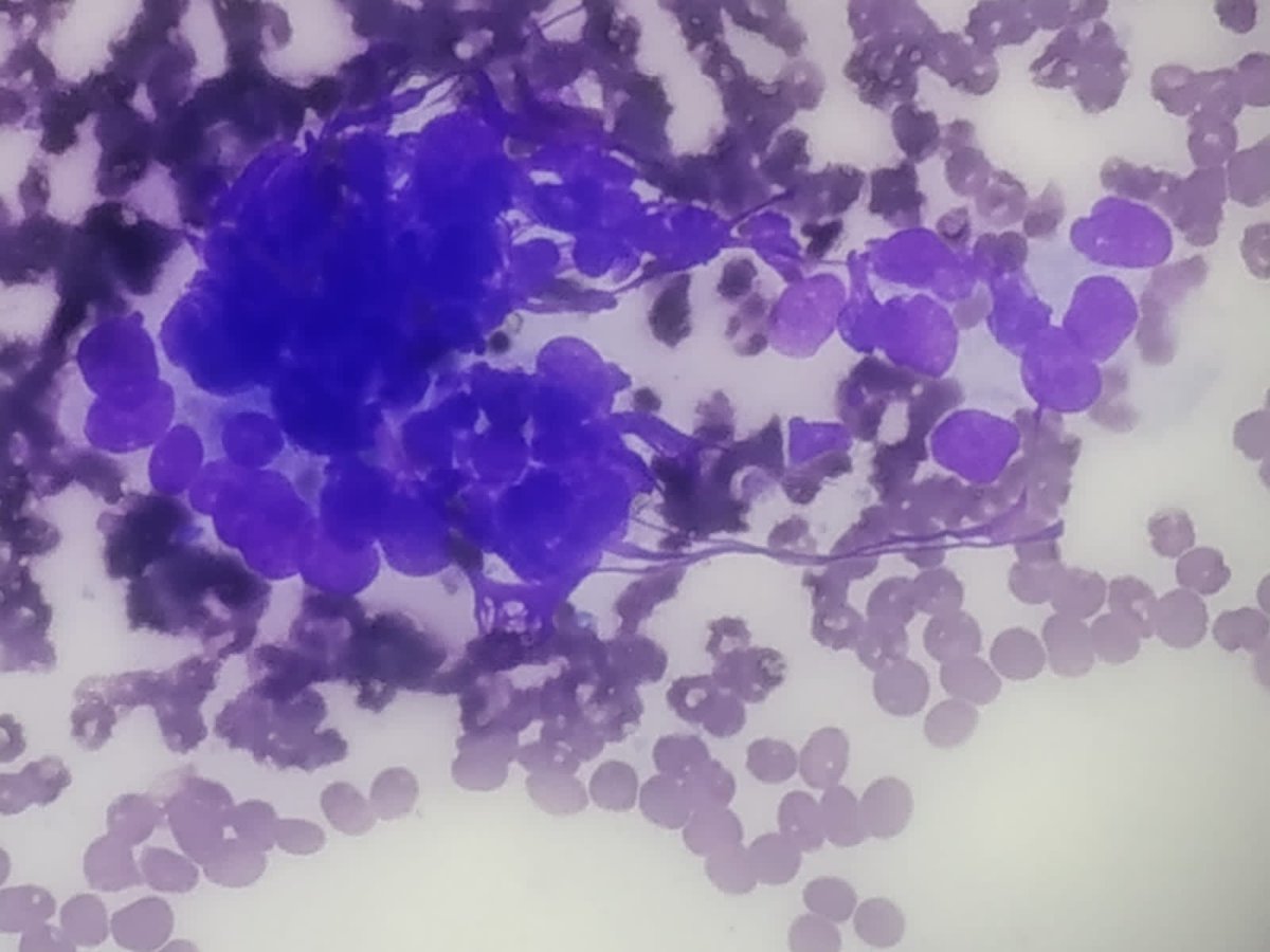 boaz_mwesigwa's tweet photo. 50yr/F with a thyroid lesion >10years, mobile &amp; solid. Your opinions please? @JASCJOURNAL @MusokeSharrifMD @Cytology_Uganda @pathologyCast @IACytology @COPECSA1 @CancerCytopath @SocietyMsoc @ACitopatologia @KenyaKacp @cytopathology https://t.co/9JMxgVaGUG