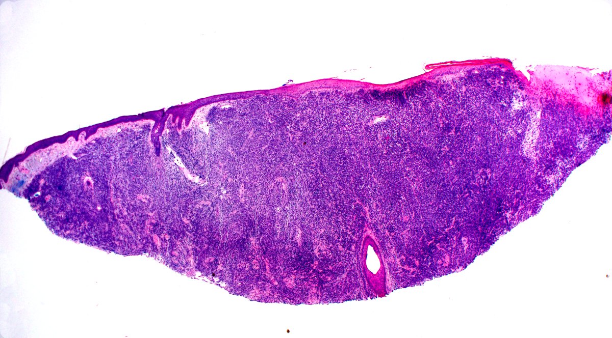 alegru18's tweet photo. An 81-year-old male presented to his dermatologist with an ulcerated pink nodule on the right lower cheek that arose 3 months prior and had rapidly grown to 3 cm. https://t.co/uhhwvecMVD