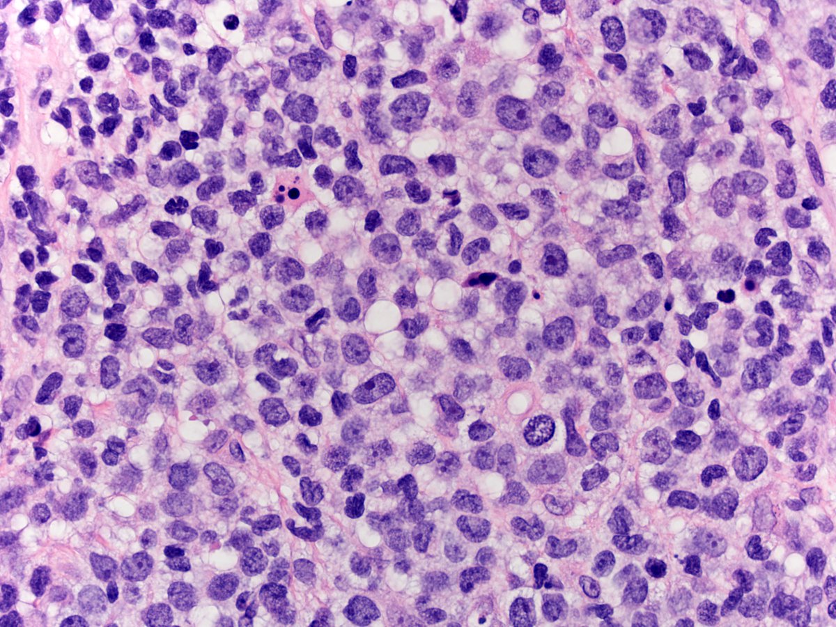 alegru18's tweet photo. An 81-year-old male presented to his dermatologist with an ulcerated pink nodule on the right lower cheek that arose 3 months prior and had rapidly grown to 3 cm. https://t.co/uhhwvecMVD