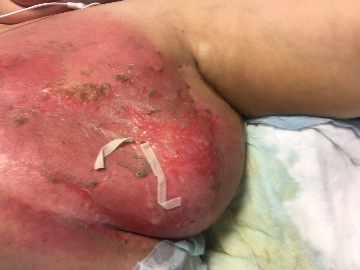 Tina_read2learn's tweet photo. 36 Protón radiation treatments later…wound packed wound vac taped on https://t.co/bs3cnbhyAI