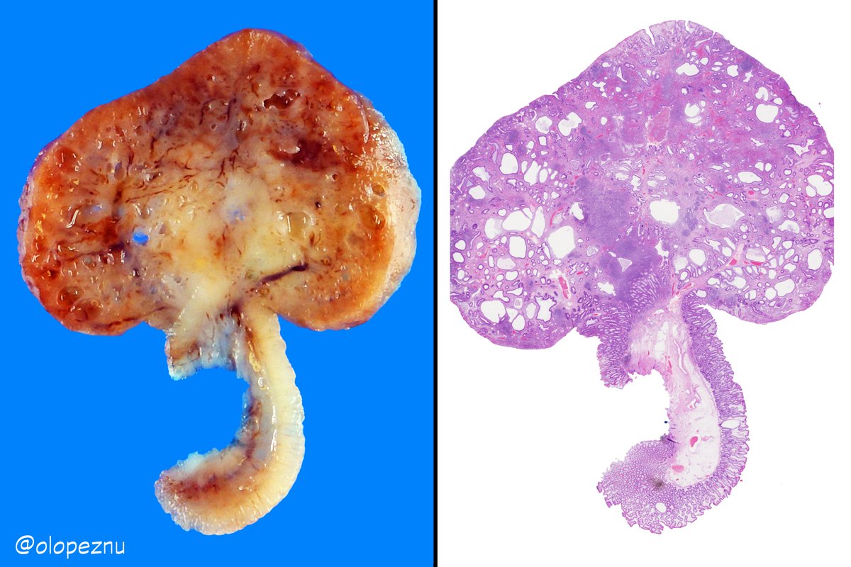 olopeznu's tweet photo. Juvenile Polyp
✔️Most common polyp in children
✔️More than 1/2 in the rectosigmoid colon
✔️Can be sporadic or syndromic (JPS)
✔️SMAD4/BMPR1A mutations ~ 50% of JPS families
✔️Histologically identical polyps can be seen in other hamartomatous polyposis syndromes
#PediPath #GIpath https://t.co/YQXmkllOoZ