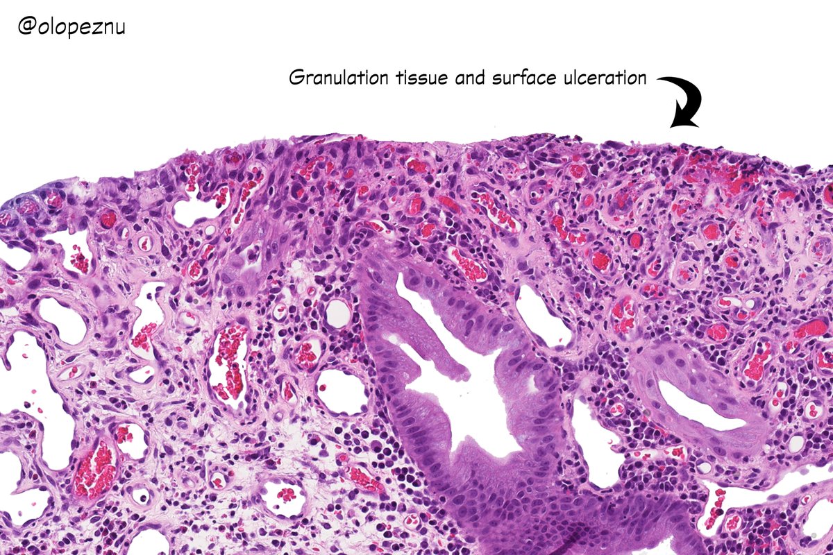 Juvenile Polyp
✔️Most common polyp in children
✔️More than 1/2 in the rectosigmoid colon
✔️Can be sporadic or syndromic (JPS)
✔️SMAD4/BMPR1A mutations ~ 50% of JPS families
✔️Histologically identical polyps can be seen in other hamartomatous polyposis syndromes
#PediPath #GIpath