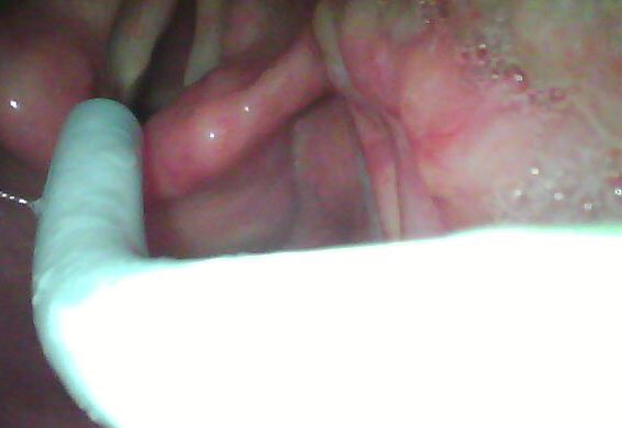 NaveenEipe's tweet photo. @EM_RESUS @JohnCSakles @doctimcook @KalagaraHari @dr_imranahmad @drlauraduggan @DrMikeAziz @dasairway @NicholasChrimes @elboghdadly @AirwayMxAcademy Std. geometry blades #MacVL
also have the advantage of allowing for #Bougie use?! https://t.co/53WjJvyDva