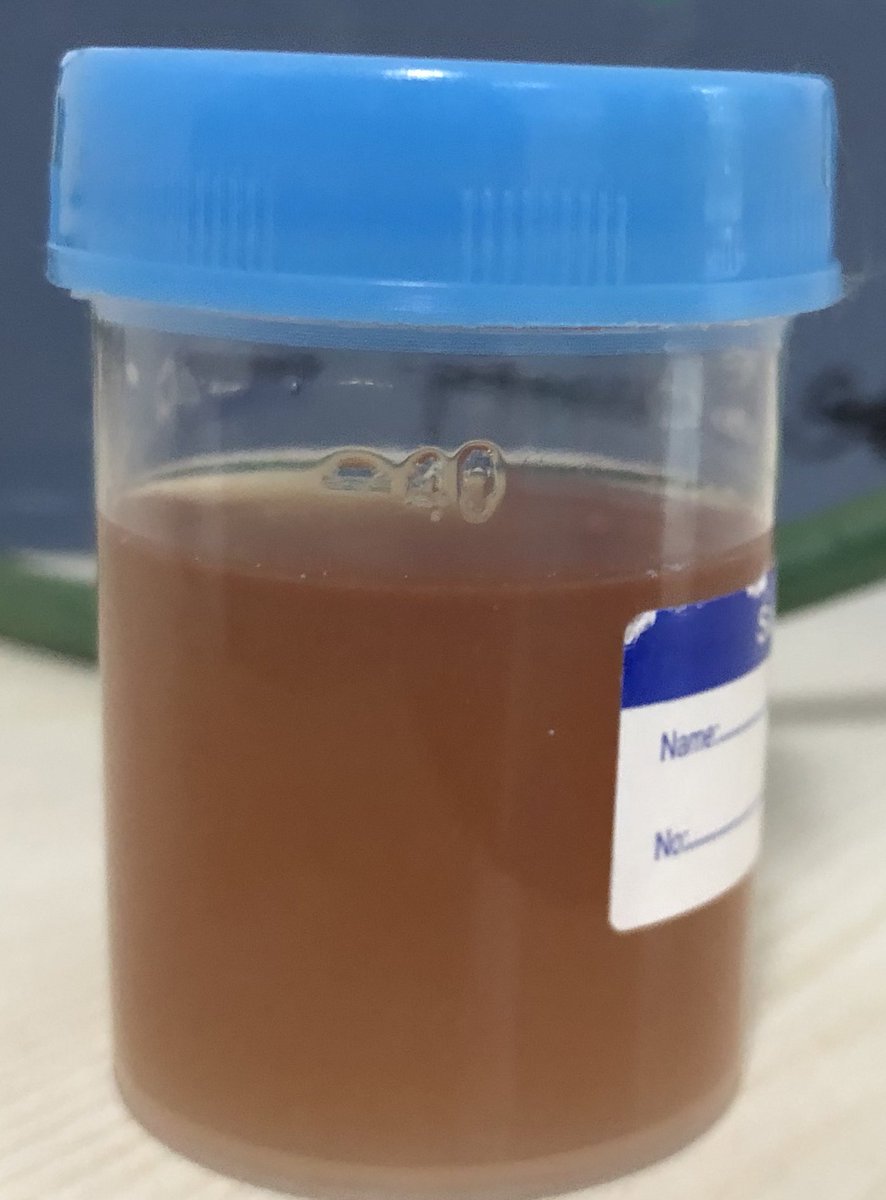 nadig_cardio's tweet image. 45/m, multiple stents- LAD, cx and rca, 3 months post pci, dapt+crestor40-severe backache and thigh pain;cpk^10000 times URL, creat2.6mg/dl- rare yet dangerous complication of high dose statin therapy -rhabdomyolysis with myoglobinuria #cardiotwitter #AstraZeneca #cardiobot