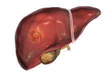 Durvalumab monotherapy was also found to be noninferior to sorafenib, with a numerical trend in favor of the former. Single-agent durvalumab also had better tolerability than sorafenib. <a href="/GABOUALFA/">Ghassan Abou-Alfa</a> @sloan_kettering #livercancer ow.ly/f9ve50GxV1h