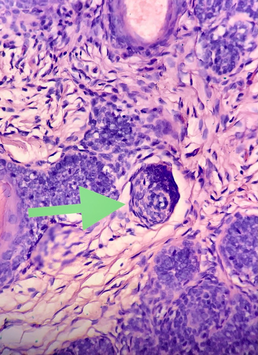 Trichoepithelioma
-BCC-like @ low power but:
-Keratocysts
-Follicular stroma
-No peritumoral clefts
-No atypia
-Papillary mesenchymal bodies (arrow)
-CD34+ stroma
-Multiple: Multiple familial TEP, Brooke-Spiegler, Rombo &amp; Bazex-Dupré-Christol syndromes
#dermpath #pathtwitter