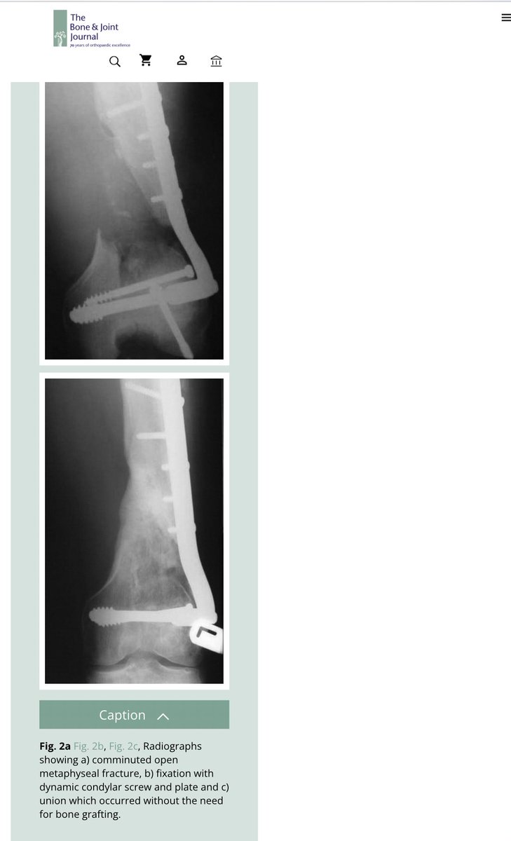 Lee Van Rensburg (@gnomelover1970) on Twitter photo <a href="/sortabonefixer/">Mexican Ortho</a> I like Masqualet.
Sorry <a href="/mkrkovic/">Matija Krkovic</a> .
But did it need it?
Great article from Edinburgh
<a href="/EdinburghTrauma/">Edinburgh Orthopaedics — Trauma</a>
On bone loss and fractures.
Non critical defect particularly in adolescent, high chance it will fill in on its own.
online.boneandjoint.org.uk/doi/full/10.13… <a href="/sortabonefixer/">Mexican Ortho</a> I like Masqualet.
Sorry <a href="/mkrkovic/">Matija Krkovic</a> .
But did it need it?
Great article from Edinburgh
<a href="/EdinburghTrauma/">Edinburgh Orthopaedics — Trauma</a>
On bone loss and fractures.
Non critical defect particularly in adolescent, high chance it will fill in on its own.
online.boneandjoint.org.uk/doi/full/10.13…
