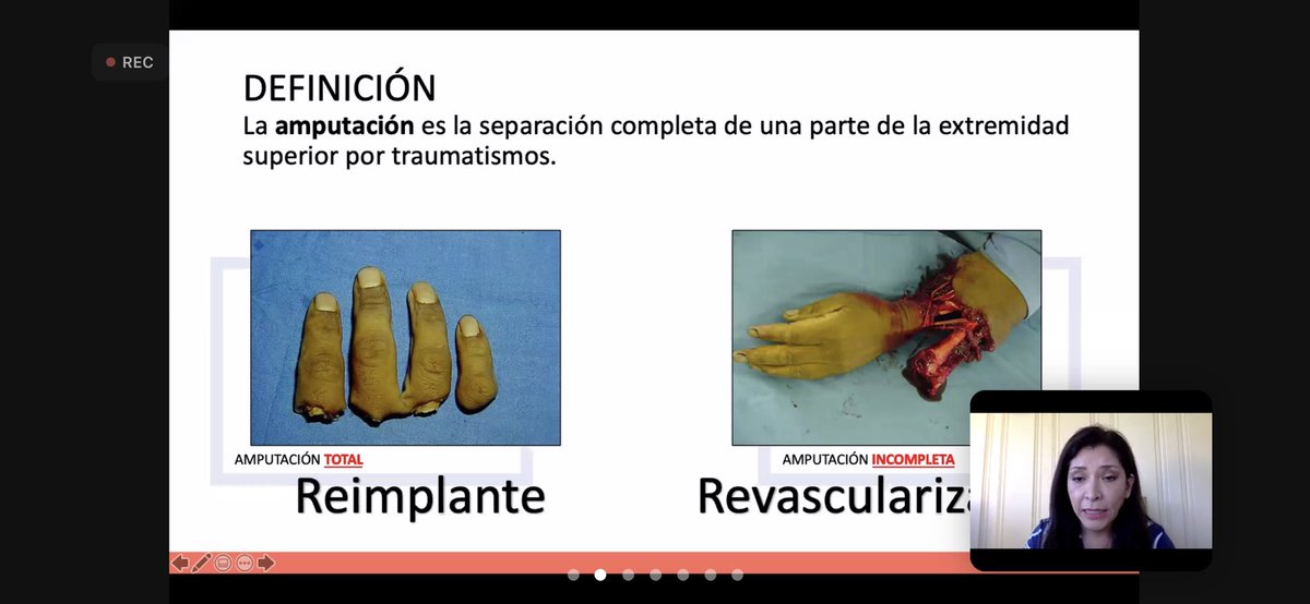 La 𝗗𝗿𝗮. 𝗣𝗮𝘁𝗿𝗶𝗰𝗶𝗮 𝗕𝘂𝘁𝗿ó𝗻, de México 🇲🇽habla sobre 𝚁𝙴𝙸𝙼𝙿𝙻𝙰𝙽𝚃𝙴 𝙳𝙴 𝚂𝙴𝙶𝙼𝙴𝙽𝚃𝙾𝚂 𝙰𝙼𝙿𝚄𝚃𝙰𝙳𝙾𝚂 en 𝕀𝕏 𝕁𝕆ℝℕ𝔸𝔻𝔸𝕊 𝕀ℕ𝕋𝔼ℝℕ𝔸ℂ𝕀𝕆ℕ𝔸𝕃𝔼𝕊 𝔻𝔼 ℂ𝕀ℝ𝕌𝔾Í𝔸 ℙ𝕃Á𝕊𝕋𝕀ℂ𝔸 <a href="/Secpre_Guayas/">SECPRE_Guayas</a> 
#cirujanosplasticos #Guayaquil