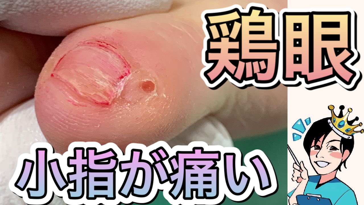 巻き爪王子 巻き爪王子の足チャンネル 本日は 足の小指爪の横の爪の が痛い こちらの原因について解説 お困りの方には是非ご覧ください とにかく小指が痛い T Co 8mijdfzi7k 副爪 巻き爪 巻き爪王子 菊池直樹 T Co 巻き爪王子 巻き爪王子の足チャンネル 本日は 足の小指爪の横の爪の が痛い こちらの原因について解説 お困りの方には是非ご覧ください とにかく小指が痛い T Co 8mijdfzi7k 副爪 巻き爪 巻き爪王子 菊池直樹 T Co