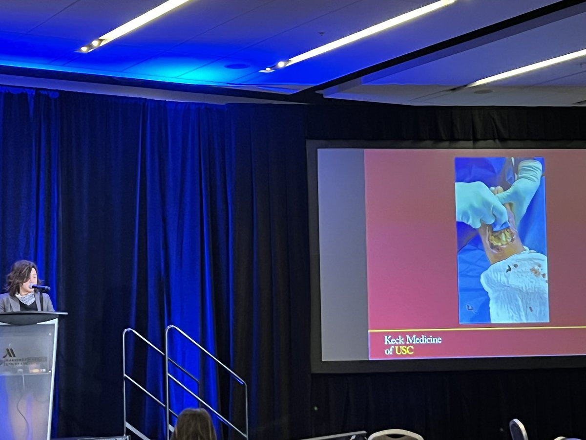 DGArmstrong's tweet photo. Tips and tricks on debridement and skin grafting from our world class partner Dr. Laura Shin. @usc_vascular #DFCON21 #ActAgainstAmputation #DiabeticFoot #ALPSlimb https://t.co/XXf0GXh8Do
