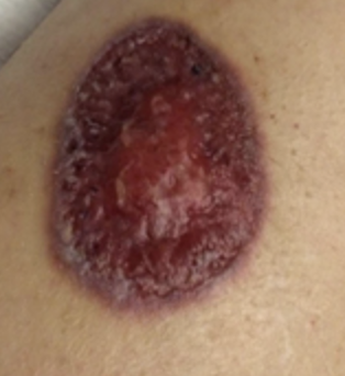 IUIDfellowship's tweet photo. #idboardreview A pt w/skin lesions on flank, thighs, feet &amp; wrist x couple of months, not improved w/ doxy, now progressive back pain and wrist pain. CT lytic lesions in spine. biopsy shown. Dx? #medEd #idmeded #idtwitter #dermtwitter https://t.co/G5iAkIdfqB