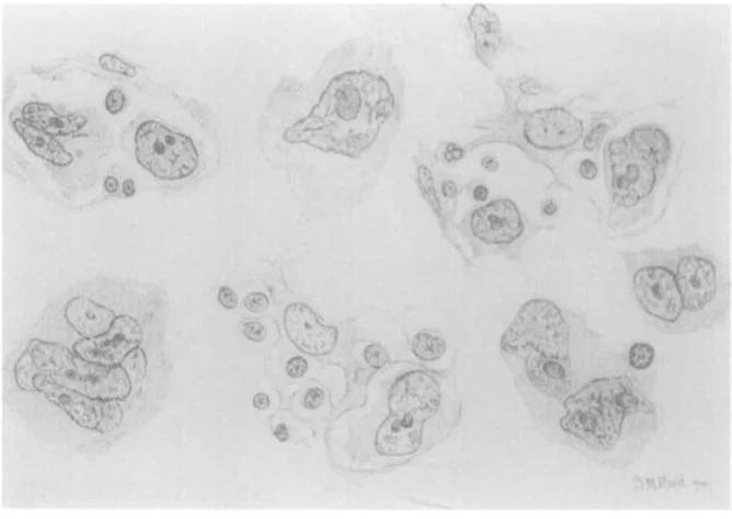 AvrahamCooperMD's tweet photo. More people should know Dr. Dorothy Reed’s name:
✅ Described the pathognomonic cell in Hodgkin’s, which eventually was named the Reed-Sternberg cell
✅ Proved Hodgkin’s isn’t caused by TB (19th century misconception)
✅ One of the 1st female residents at Hopkins
#MedTwitter https://t.co/UOnzDJCA0Z