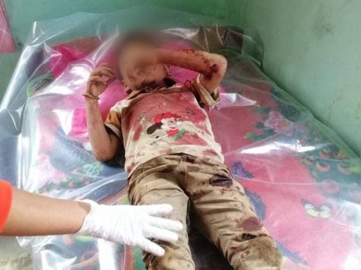 #Oct24Coup Mobye Township

SAC ARTILLERY SHELLS INJURE 5 INC YOUNG CHILDREN 

Early am: 5 people including two children,  1 &amp; 4,  were seriously injured due to exploding artillery shells Mobye Township, bordering Shan State &amp; Kayah State. Khit Thit. #WhatsHappeningInMyanmar