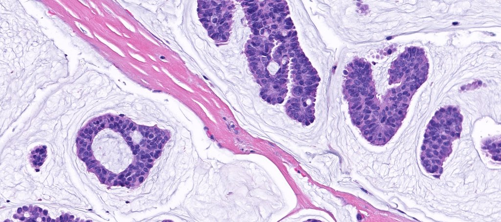 JMGardnerMD's tweet photo. 75 yo man w a nodule on the eyebrow. A perfect example of this entity! Reply with your diagnosis then click link to see answer &amp; amazing WSI digital slide of this case: https://t.co/R7mwVxeD9a. #Pathology #dermpath #dermatology #dermatologia #dermtwitter https://t.co/r2dW71gy64