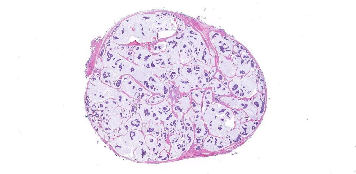 JMGardnerMD's tweet photo. 75 yo man w a nodule on the eyebrow. A perfect example of this entity! Reply with your diagnosis then click link to see answer &amp; amazing WSI digital slide of this case: https://t.co/R7mwVxeD9a. #Pathology #dermpath #dermatology #dermatologia #dermtwitter https://t.co/r2dW71gy64