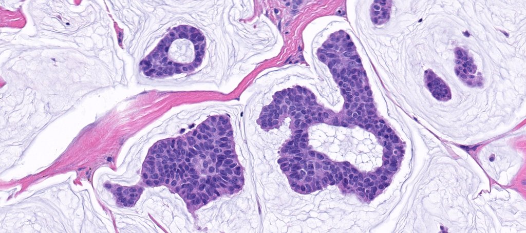 JMGardnerMD's tweet photo. 75 yo man w a nodule on the eyebrow. A perfect example of this entity! Reply with your diagnosis then click link to see answer &amp; amazing WSI digital slide of this case: https://t.co/R7mwVxeD9a. #Pathology #dermpath #dermatology #dermatologia #dermtwitter https://t.co/r2dW71gy64