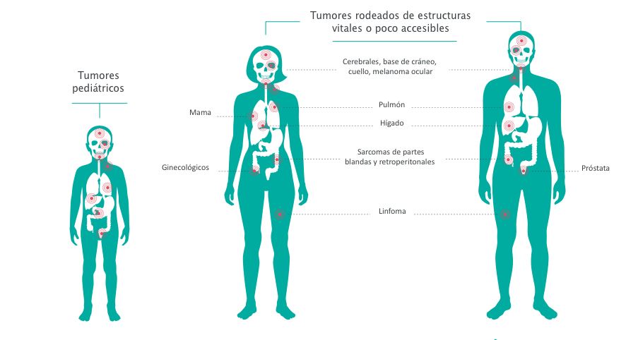 #ProtonterapiaQuirónsalud La terapia de protones es el tratamiento ideal para tumores sólidos localizados cerca de órganos críticos del cuerpo ow.ly/avp250Guphw