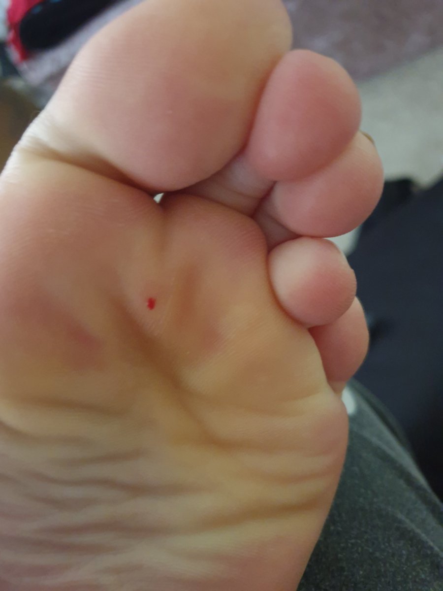 polished_toes's tweet photo. Ouch ouch ouch just stood on a pin. Any volunteers to kiss it better? https://t.co/J96eEnF6WK