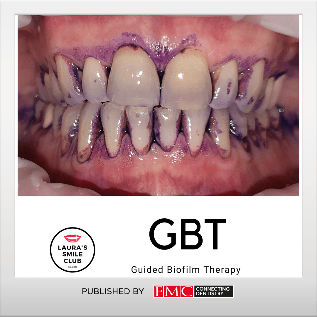 Dentistry's tweet photo. Reviving career goals with guided biofilm therapy;

Laura Bailey shares with readers why and how she came back from a break from clinical dentistry with renewed vigour, thanks to the game-changing guided biofilm therapy protocol ⬇️ 

https://t.co/gaELqm0hqH

with @emsdental https://t.co/INSyjSlfi0