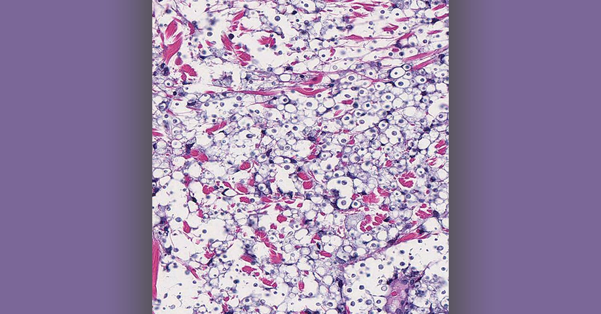 NEJM Image Challenge: A 49-year-old woman who had undergone kidney transplantation presented to the ED with history of headache, dizziness, and rash. On exam she had diffuse, umbilicated papules. What is the most likely pathogen? nej.md/2Ku5WxD