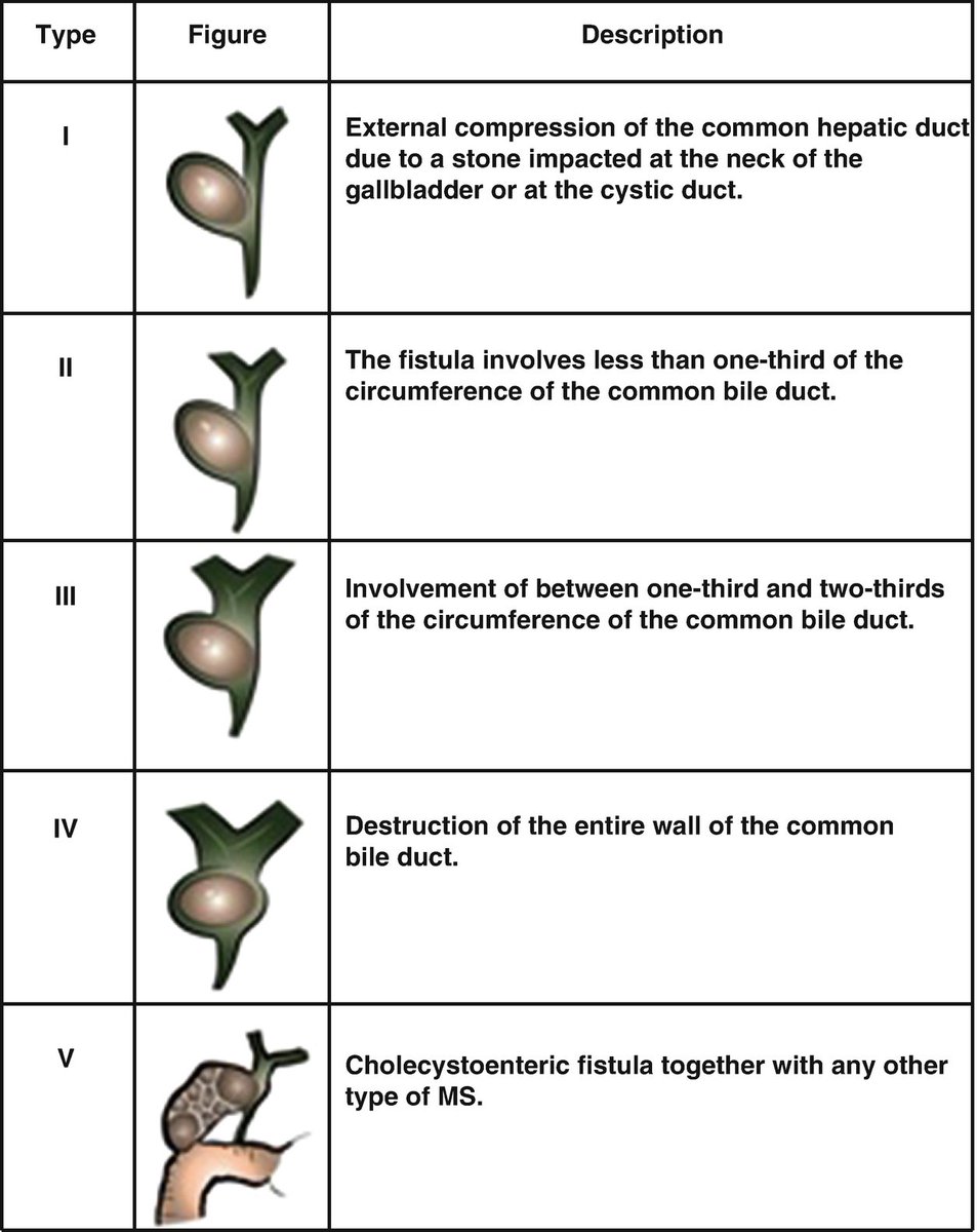 Types of Mirizzi syndrome #MedEd