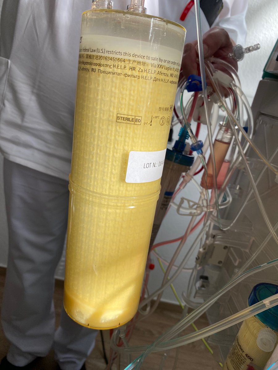 doctorasadkhan's tweet photo. It may interest you to see pictures of my clots &amp; fibrin. Usual clotting tests were normal #MedTwitter #MedEd. https://t.co/n0EPrUpU2t