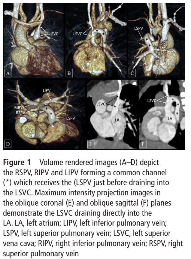 cardiopedhnn's tweet photo. @MGibreel1 @YouTube Nice case. Persistent #LSVC to CS is the must common congenital anomaly of thoracic venous system.
When PVs drain to LSVC, must commonly, 1 or all LPVs connected to LSVC.
Very rarely there is #TAPVC to LSVC (to CS or to LA w #unroof_coronary_sinus )
https://t.co/042LsM6lDP https://t.co/XDPBc9frkf