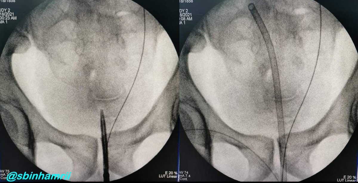 😕Could you imagine where was the tip of the introducer ?
📍Be careful with your gadgets 
<a href="/PETRAurogroup/">PETRA</a> <a href="/PEARLSendouro/">PEARLS</a>