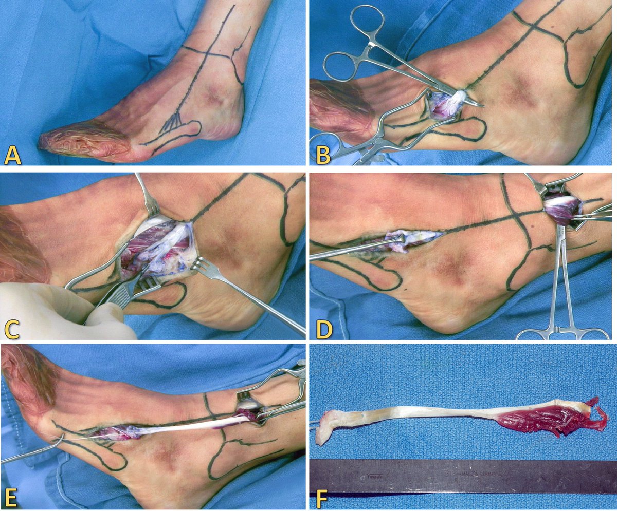 punxsy_potatoe's tweet photo. @bluestraveIer This is the best one I could find for you without requiring you take a lesson in palpation first. If you can do this, you have/had a peroneus tertius. Also, dont do this. https://t.co/HNnxca9XV3