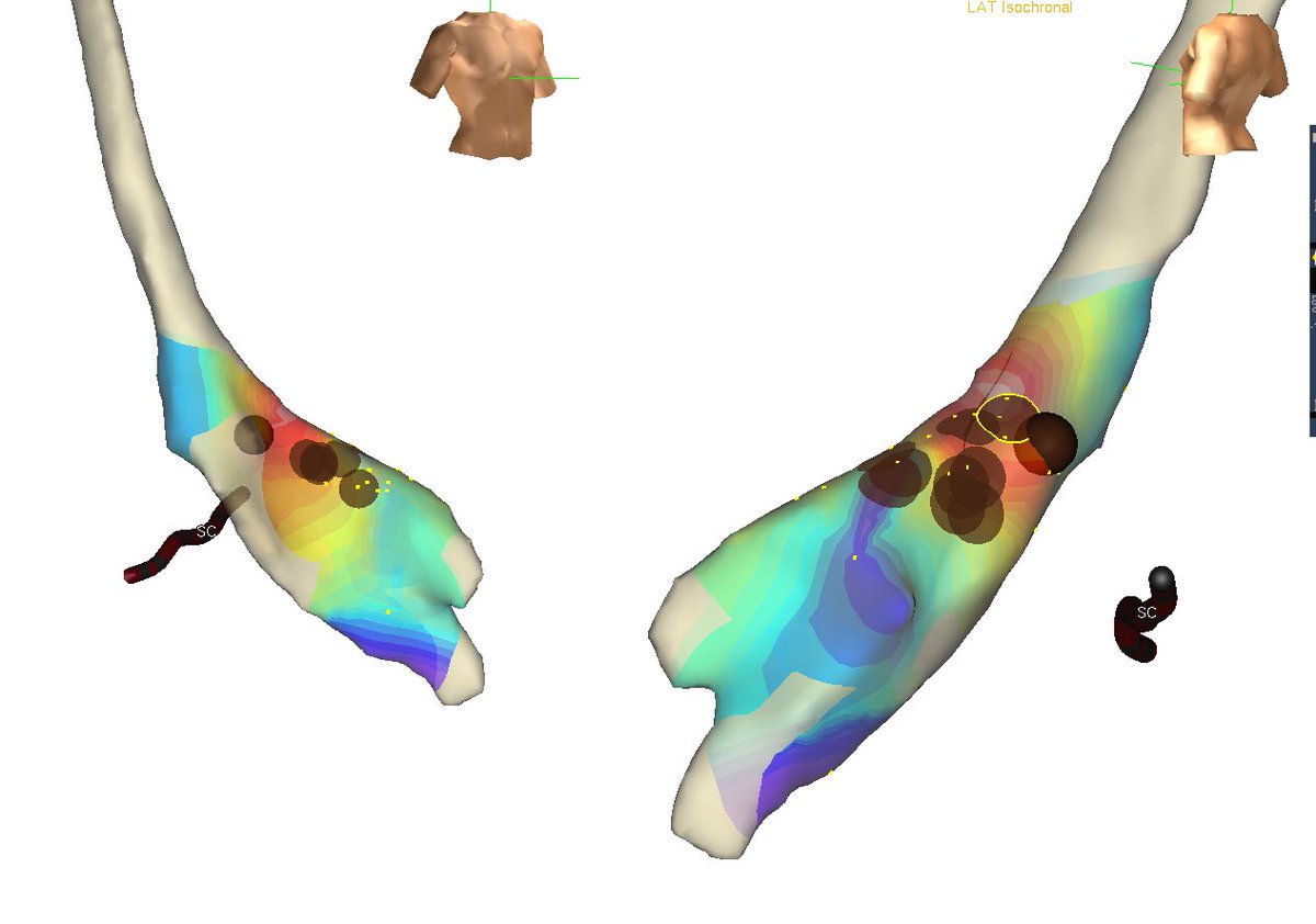 Patiet 82 YO with incessant VT originating in the left coronary cusp refractory to beta-blockers.Wouldn't someone indicate ablation due to the age of the patient? <a href="/fjmalavassi/">Federico J. Malavassi</a> <a href="/trijuanmv/">Juan Manuel Vergara EP</a> <a href="/CarinaHardy4/">CarinaHardyEP</a> <a href="/NicolsMartinen2/">Nicolás Martinenghi</a> <a href="/DavidCallans/">David Callans</a> <a href="/Davilandre/">Andre d’Avila</a> <a href="/DrFerminGarcia/">Fermin Carlos Garcia</a> <a href="/VTSymposium/">VT Symposium</a>