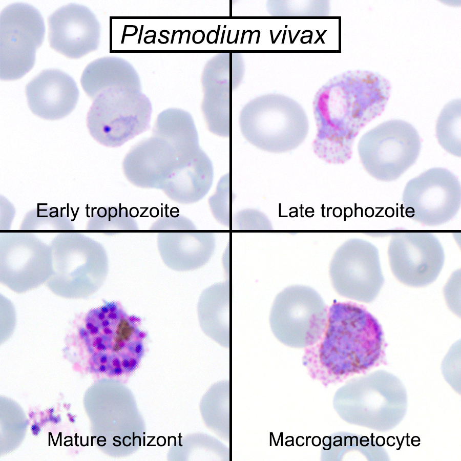Answer to the #Parasite Case 657 is up: classic forms of Plasmodium vivax - check out the description here:
parasitewonders.blogspot.com/2021/10/answer… 

#MayoClinMicro #path2path #pathology #CrittersOnTwitter
#PathBugs