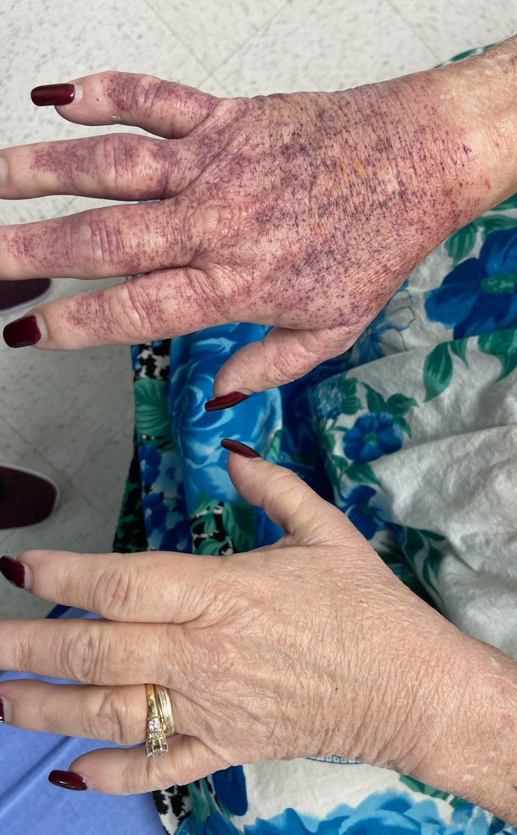 Rumpel Leede phenomenon after ulnar artery access for LHC. Petechial and nontender with distinct margin at hemostasis band. First time I’ve seen it. Benign event that resolved with time but can be alarming to patient and operator if not recognized. #RadialFirst