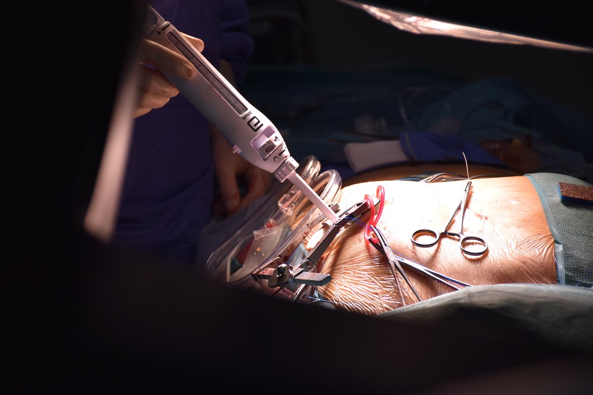 ChuSaintEtienne's tweet image. [Innovation]
Une nouvelle technique opératoire permet de remplacer la valve mitrale chez des patients inopérables par chirurgie cardiaque.
Bravo aux services de Cardiologie, Chirurgie Cardio-Vasculaire et d’Anesthésie-Réanimation du CHU de Saint-Etienne pour cette réussite!👏🏼