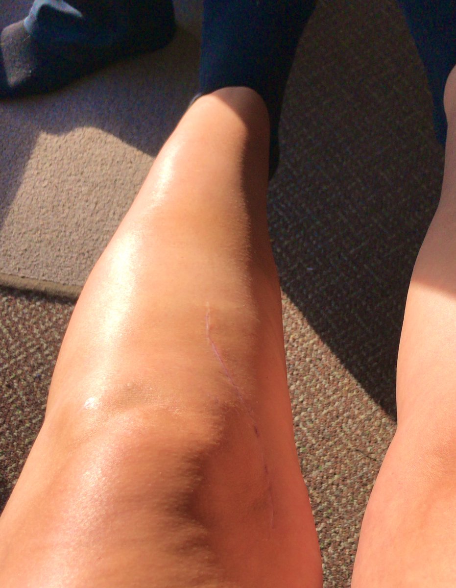 hedge2012's tweet photo. Feeling free!! The brace has gone just left with brace tan lines. Iโve never been so excited to be able to wear something other than shorts. Consultant is super happy with my recovery and will see me in feb. #gettingstronger #MCLrecovery #nowtofindmyquadsinthegym https://t.co/vlvTOYwOOu