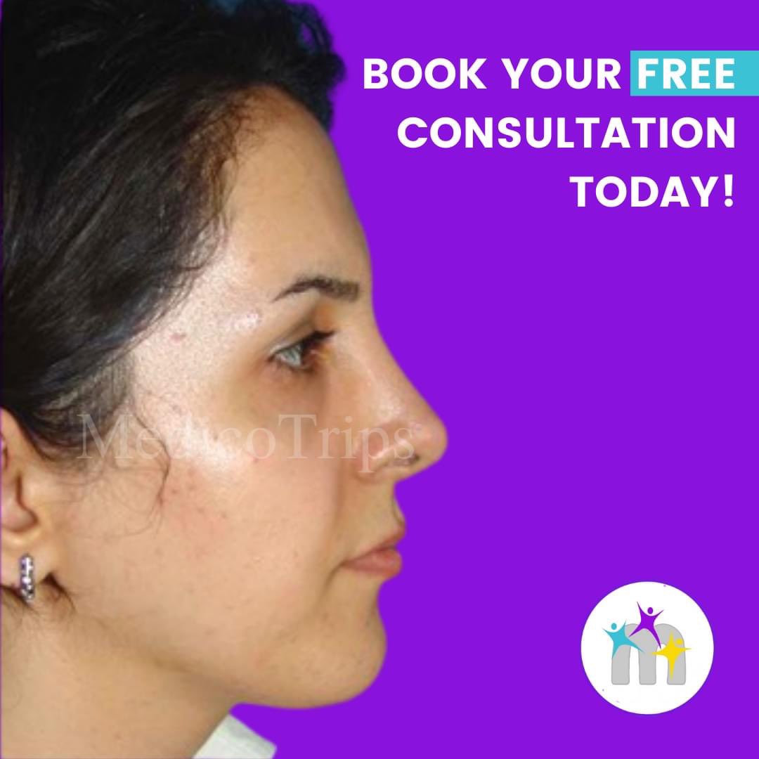 medicotrips's tweet photo. At MedicoTrips, we have hundreds of happy customers who love the final result of their nose job! π
To see more of our client transformations, head here: https://t.co/zyZA9vJquh
#rhinoplasty #nosejob #nosereshape #aestheticsurgery #nosecorrection #medicotrips https://t.co/eiDCXJNM2L
